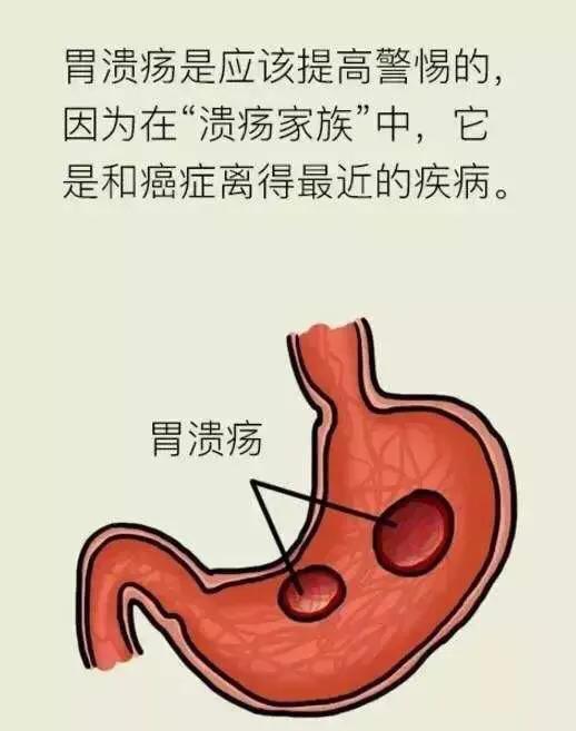 胃溃疡小知识