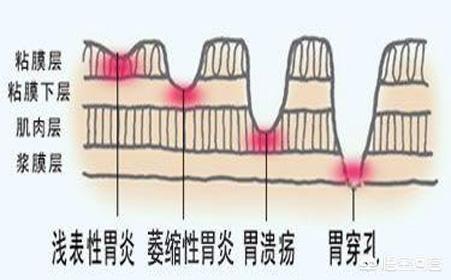 胃溃疡和胃糜烂有什么区别<strong>胃溃疡</strong>？