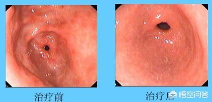 从胃炎到胃癌<strong>胃炎</strong>，仅仅只有4步，应该如何护胃？