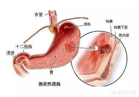 什么是十二指肠溃疡<strong>胃溃疡</strong>？