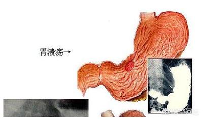 胃溃疡一喝水就会疼、反胃<strong>胃溃疡</strong>，怎么回事？
