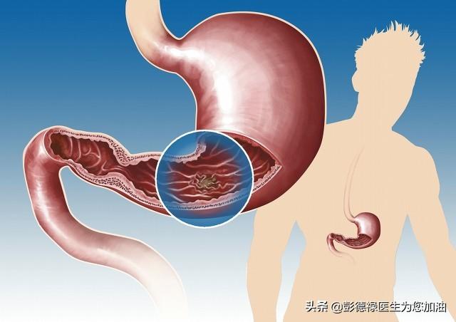 得了胃溃疡<strong>胃溃疡</strong>，十二指肠溃疡怎么办？