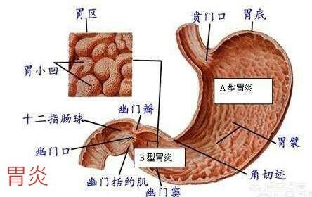 有胃炎的人能否吃南瓜<strong>胃炎</strong>？应该注意哪些事项？