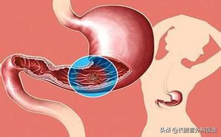 胃溃疡为什么要少食多餐<strong>胃溃疡</strong>，生活及饮食需要注意什么问题？