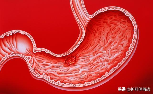 胃溃疡会出现上腹部肿块吗<strong>胃溃疡</strong>？