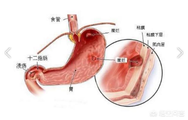胃痛是哪些原因造成的<strong>胃脘痛</strong>？