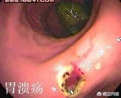 饭后胃痛是怎么回事<strong>胃脘痛</strong>？