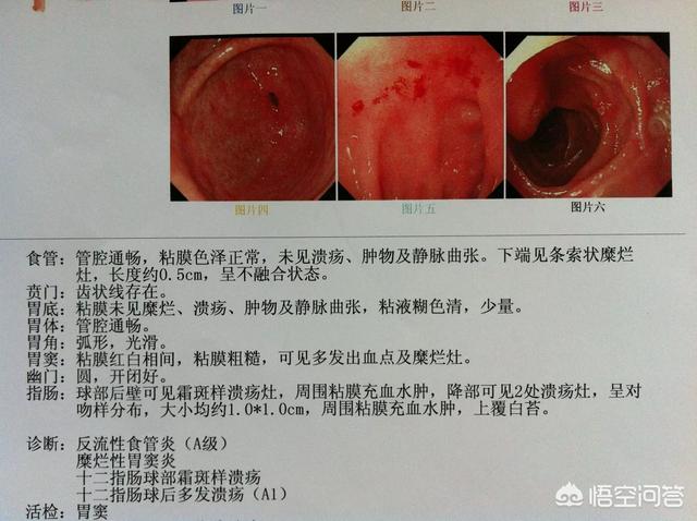 十二指肠溃疡吃什么药好<strong>十二指肠</strong>？