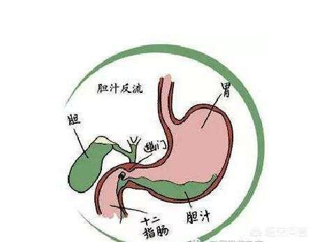 什么是十二指肠胃反流<strong>十二指肠</strong>？