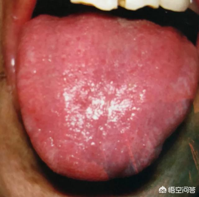 口腔溃疡怎么办<strong>胃溃疡</strong>？