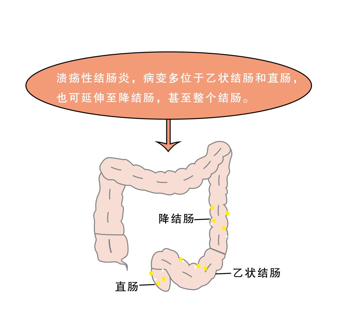 慢性肠炎症状慢性肠炎症状表现有哪些