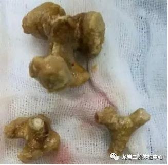 泌尿系统结石泌尿系统结石图片