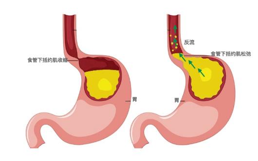 反流性食管炎症状,反流性食管炎症状一般多久能治好
