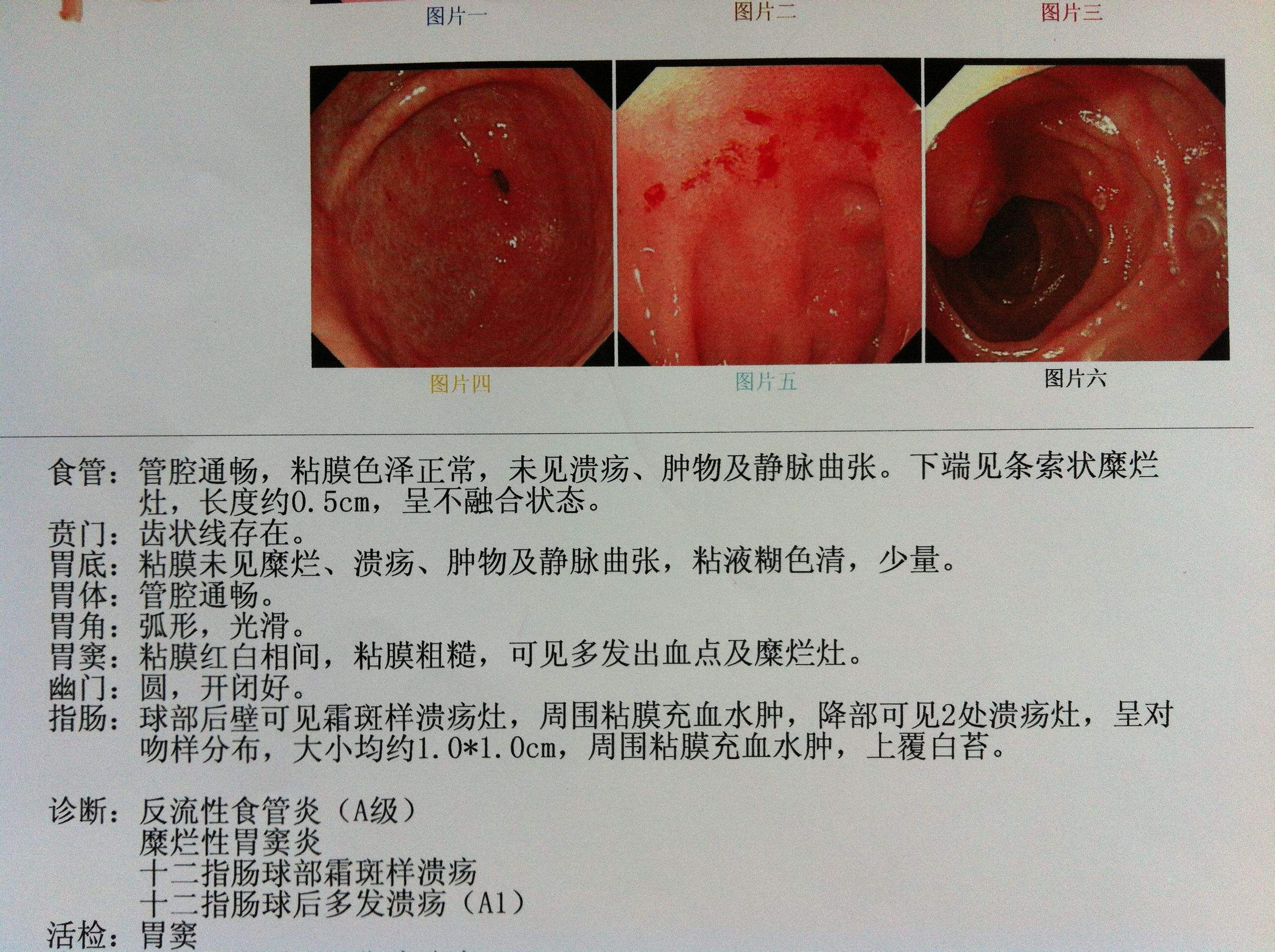 十二指肠炎的症状胃炎十二指肠炎的症状
