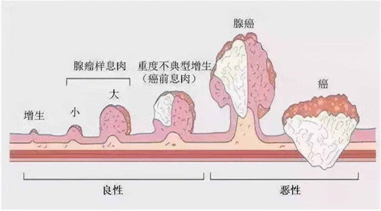 肠癌能治好吗直肠早期16个征兆