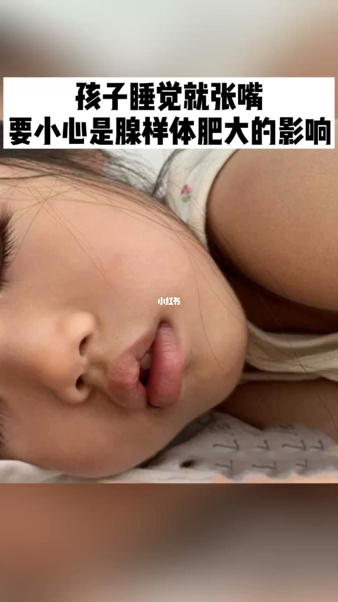 睡觉爱张嘴什么原因,睡觉时张嘴