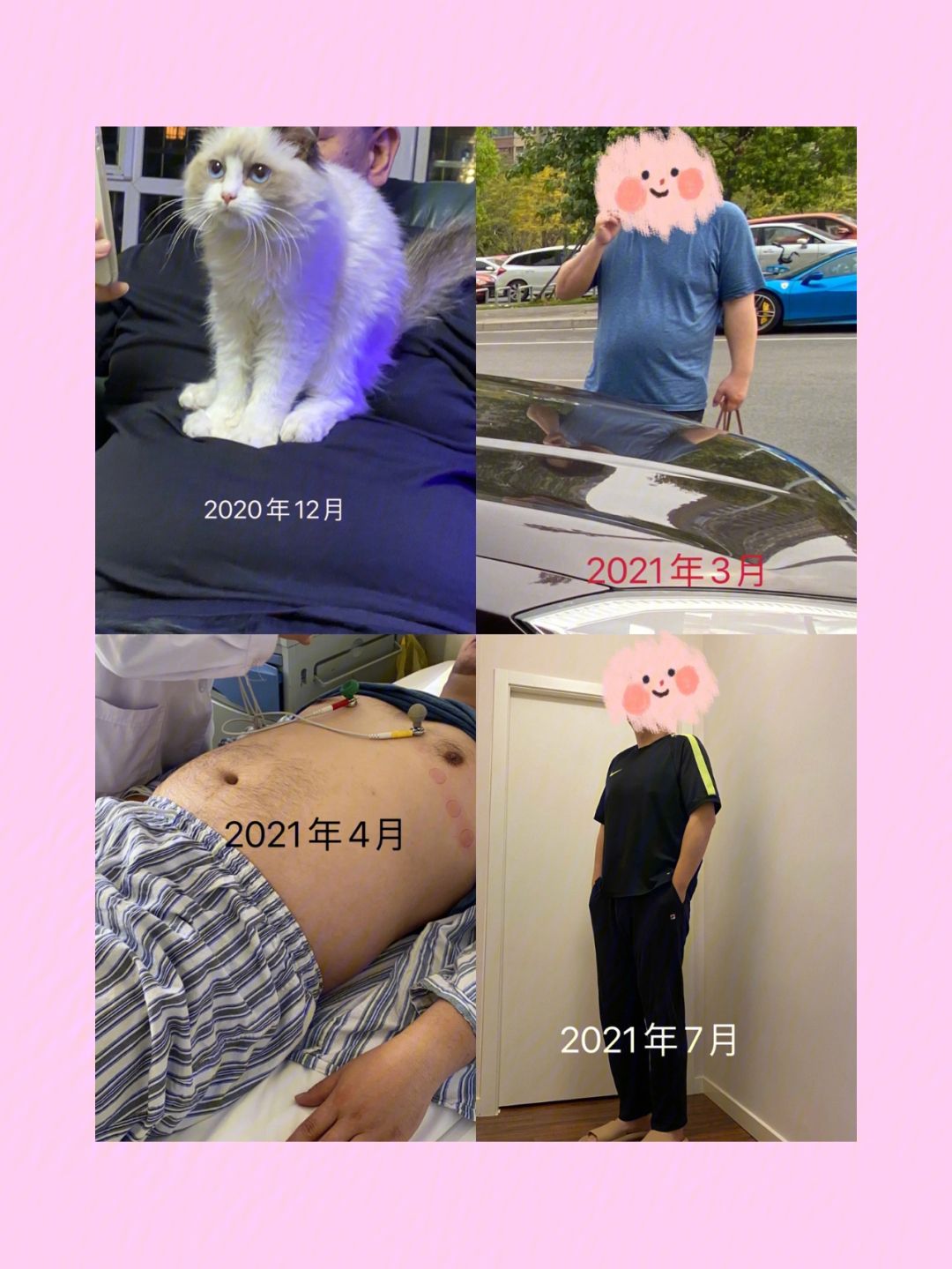 背部吸脂减肥医院脂减肥医院
