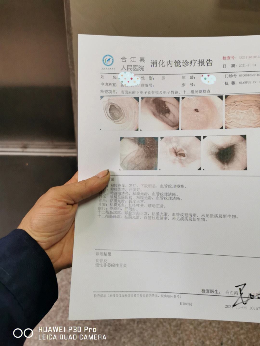 急慢性胃炎,急慢性胃炎时间如何界定