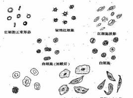尿白细胞1+是怎么回事,尿白细胞