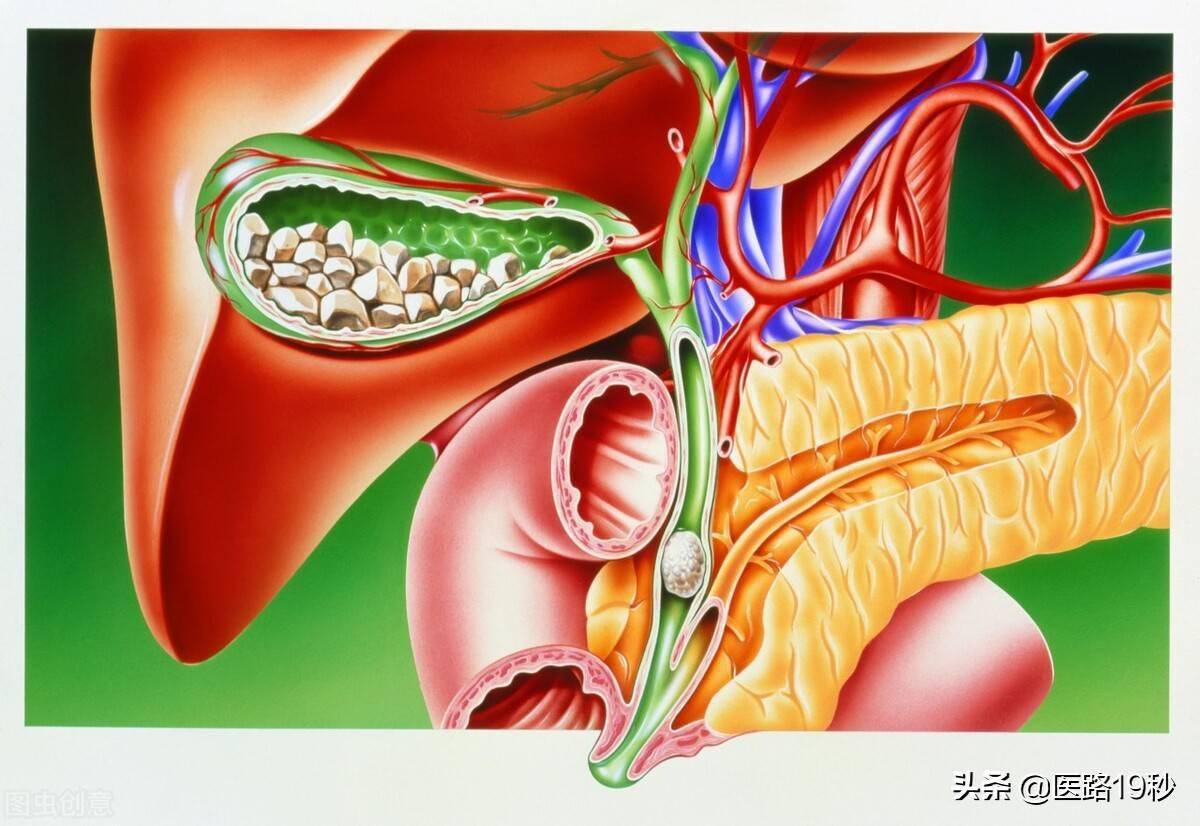 慢性胆囊炎注意事项及饮食禁忌,慢性胆囊炎