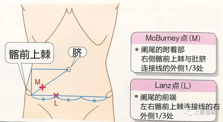 阑尾在哪个位置,阑尾在哪个位置?男女一样吗
