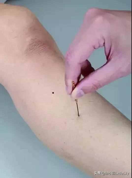 针灸治疗失眠的部位图片针灸治疗失眠的部位