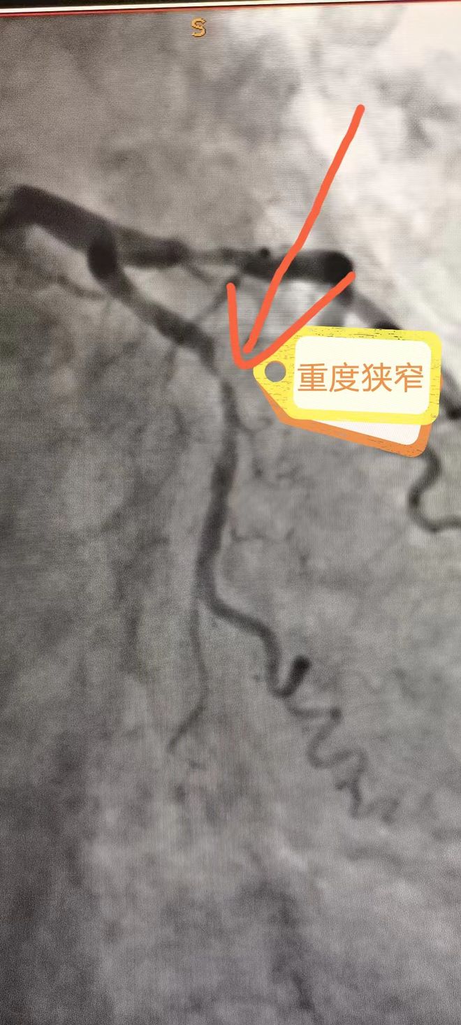 心脏造影手术是啥意思心脏造影