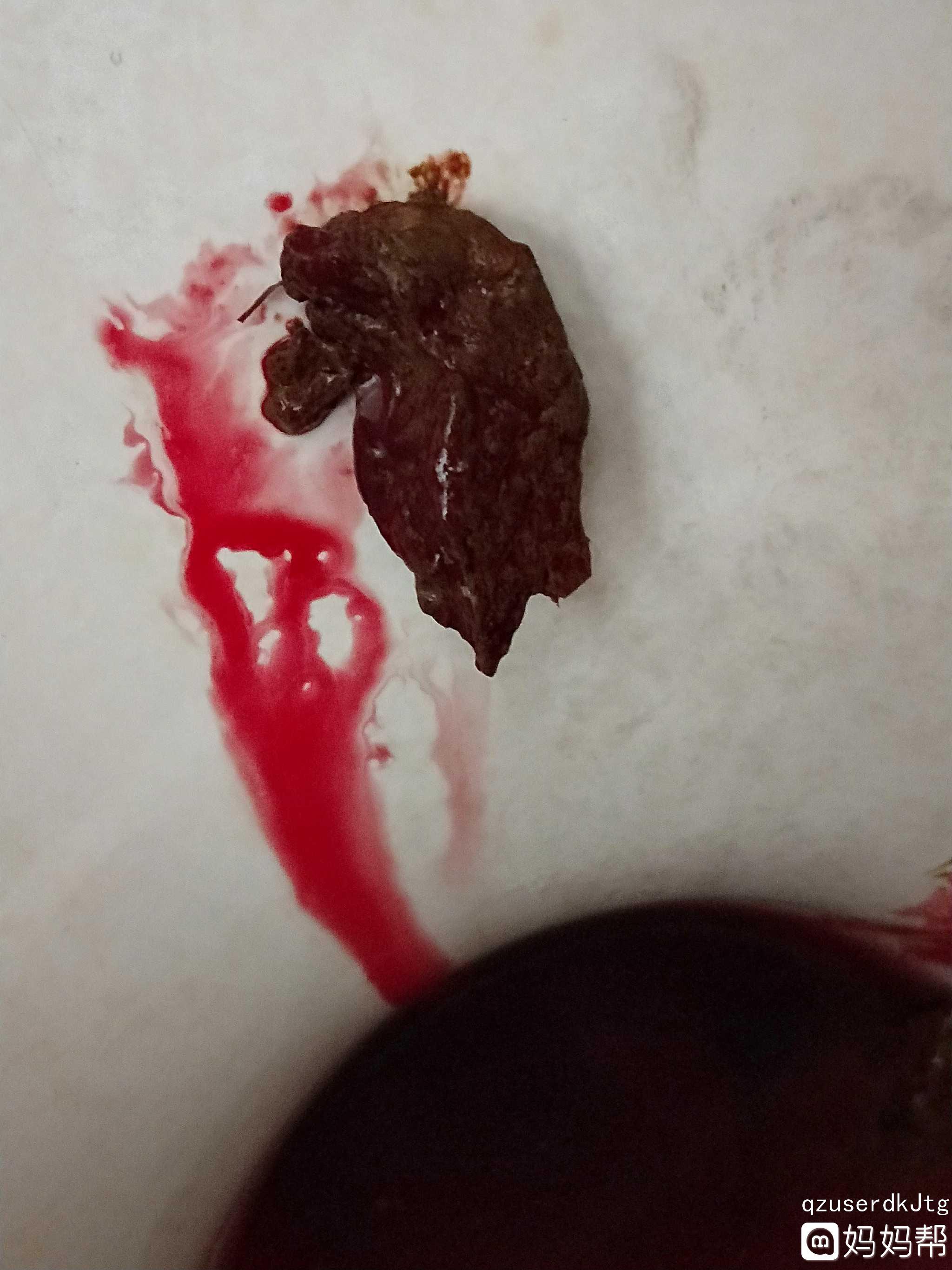 大便出血大便出血鲜红并伴有肛周疼痛