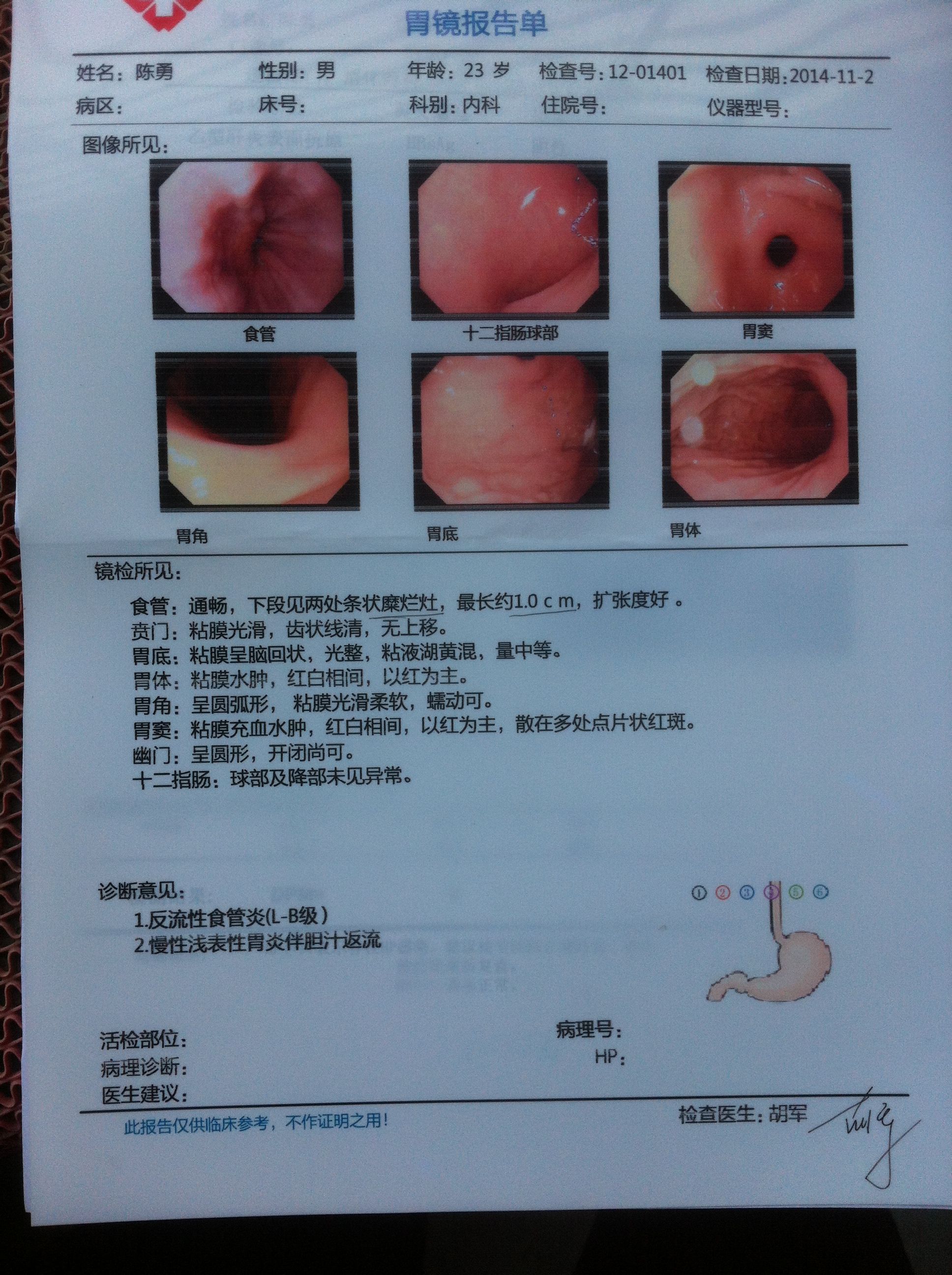 反流性食管炎怎样才能治除根吃什么药反流性食管炎怎样才能治除根