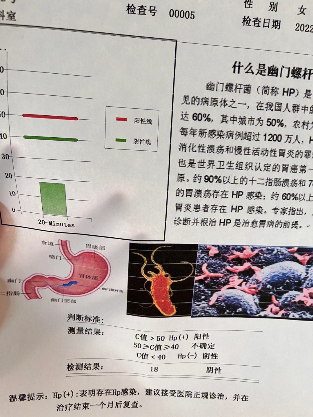 幽门螺杆菌感染阳性多少算严重的幽门螺杆菌感染阳性多少算严重