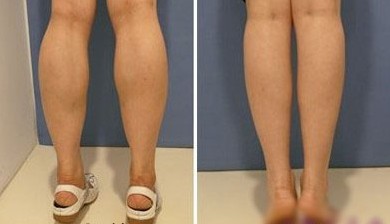 腿吸脂减肥腿吸脂减肥手术大概得多少钱