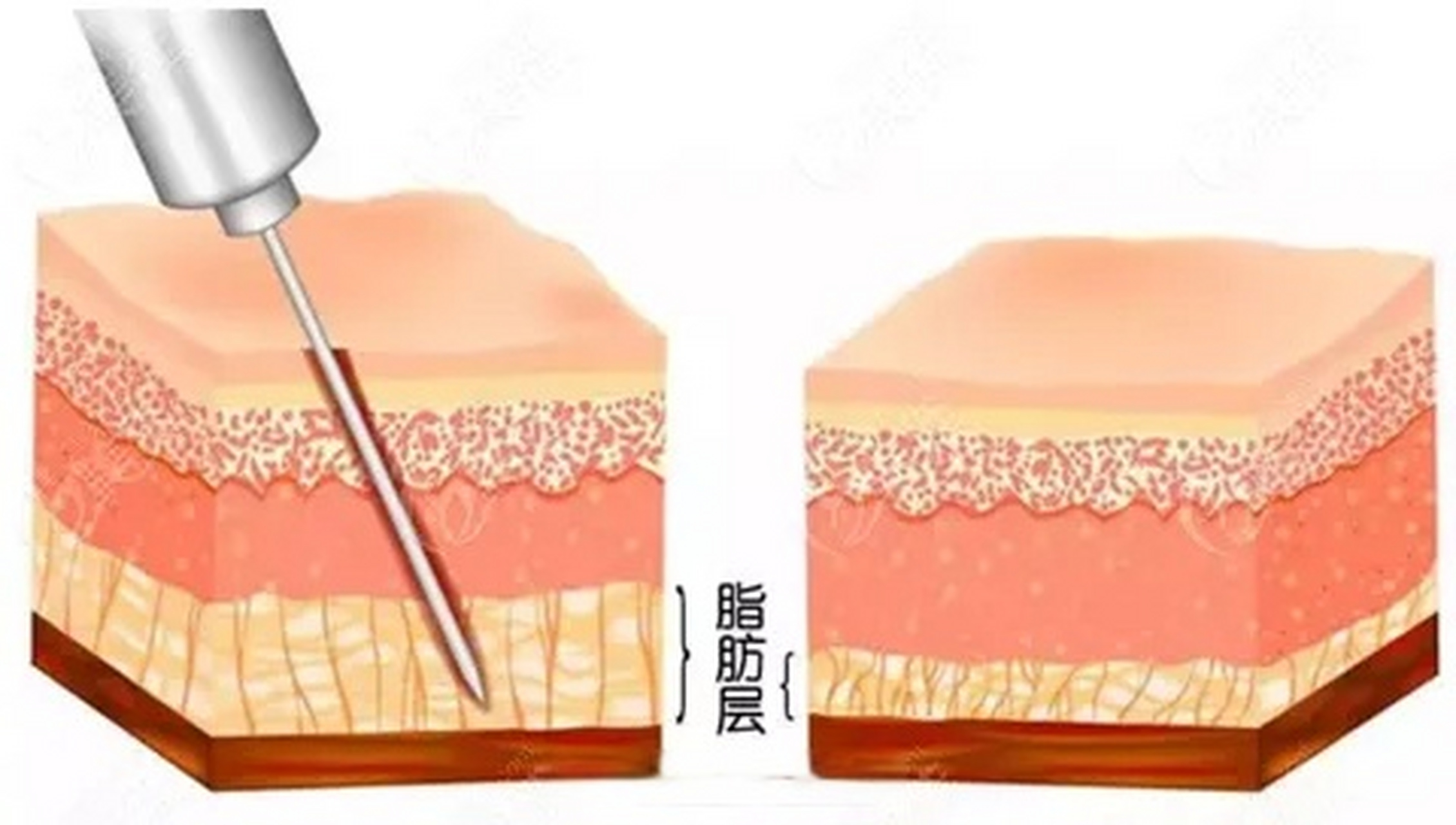 吸脂减肥多少天见效,吸脂减肥多少