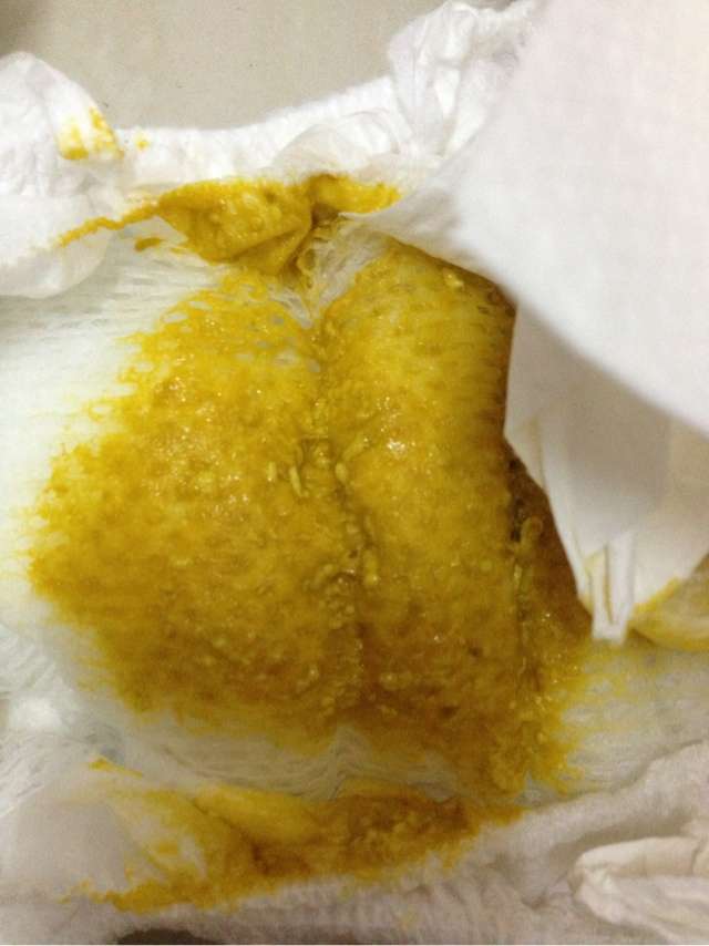 蒙脱石散,宝宝肠胃炎