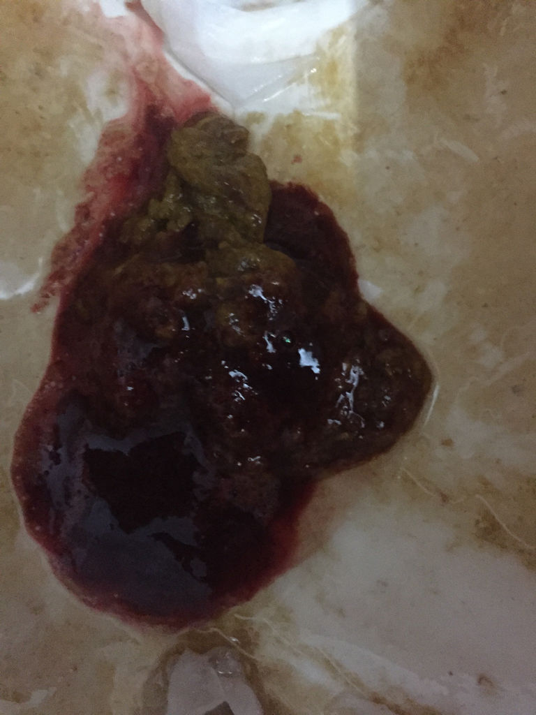 黑便是胃癌晚期症状吗黑便