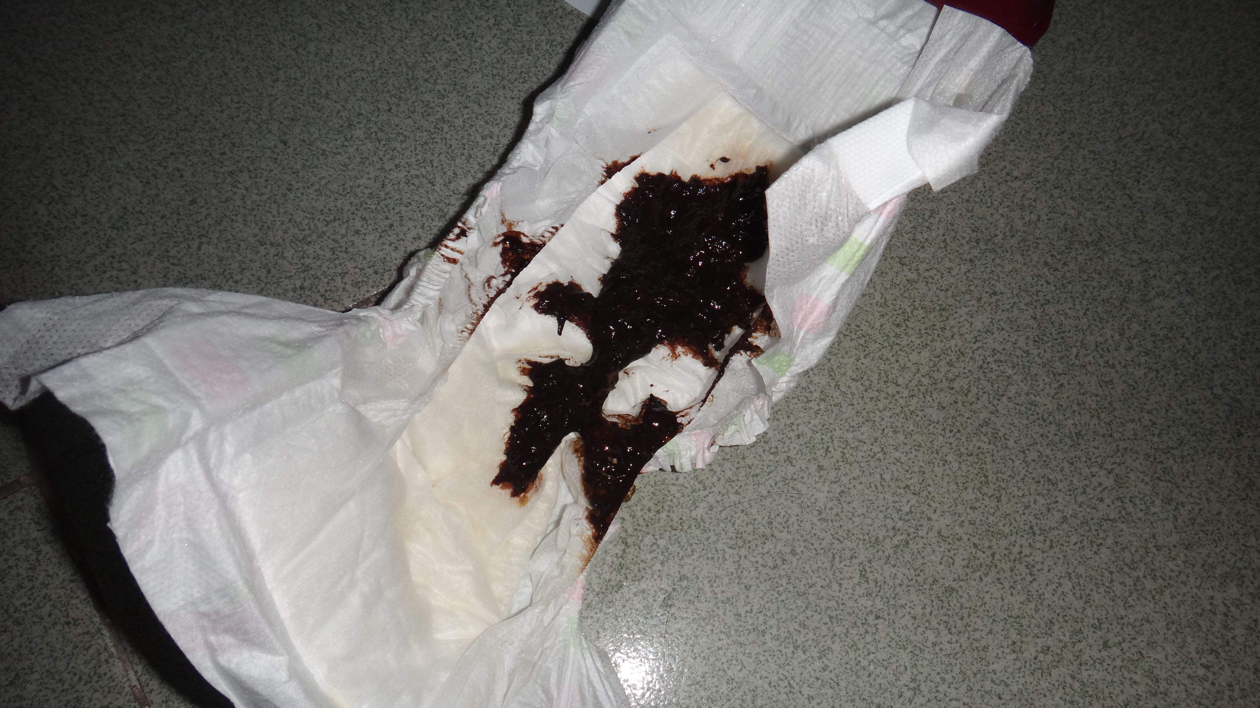 黑便是胃癌晚期症状吗黑便