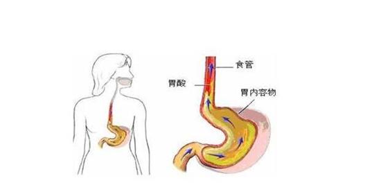 胃食管反流吃什么药最好,胃食管返流