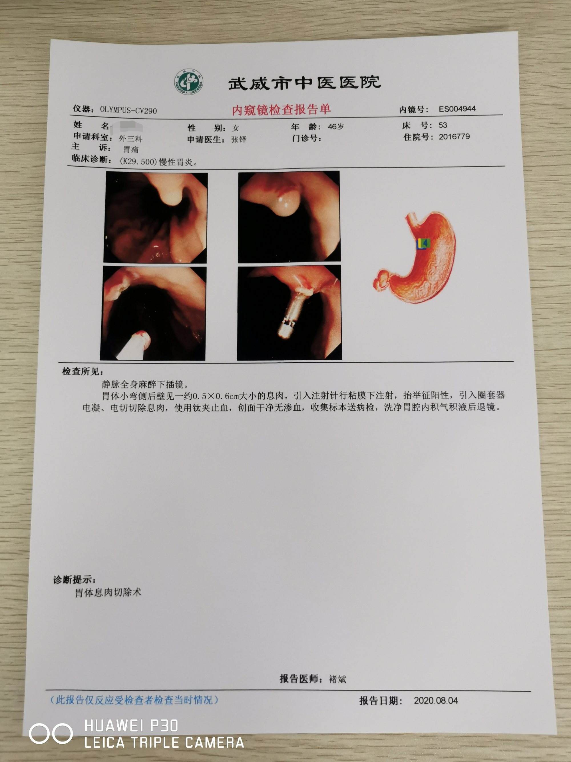 贲门息肉贲门息肉几年容易癌变