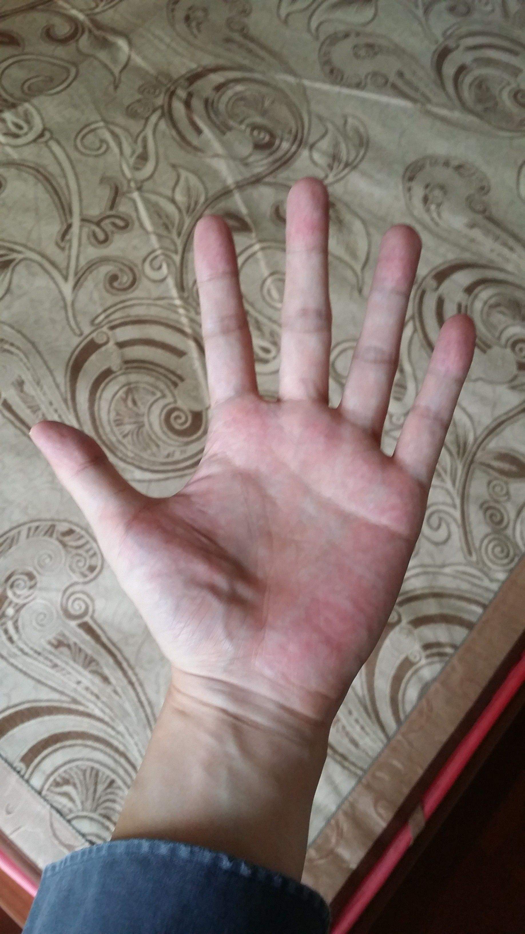肝掌图片高清图片肝掌最简单的恢复方法