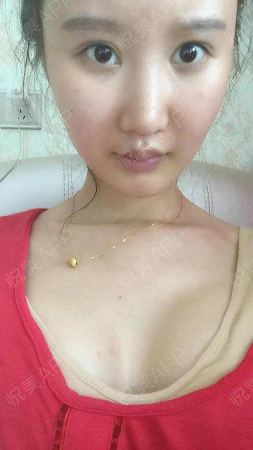 减肥是真的吗,减肥胸