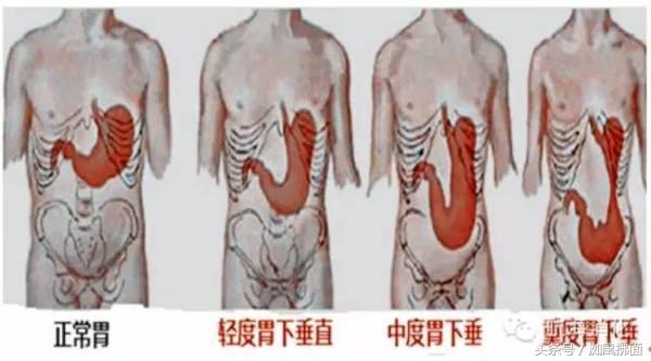 胃下垂