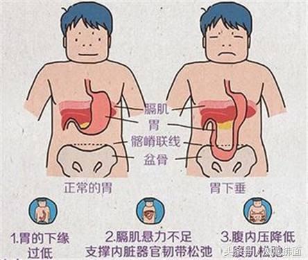 胃下垂
