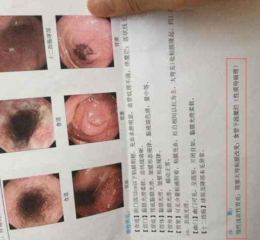 糜烂性胃炎,治疗糜烂性胃炎特效药
