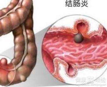结肠炎有什么症状表现,结肠炎