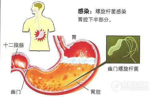 感染幽门螺旋杆菌症状的简单介绍