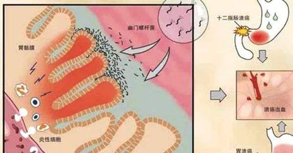 幽门螺旋杆菌的正常值范围c13的简单介绍