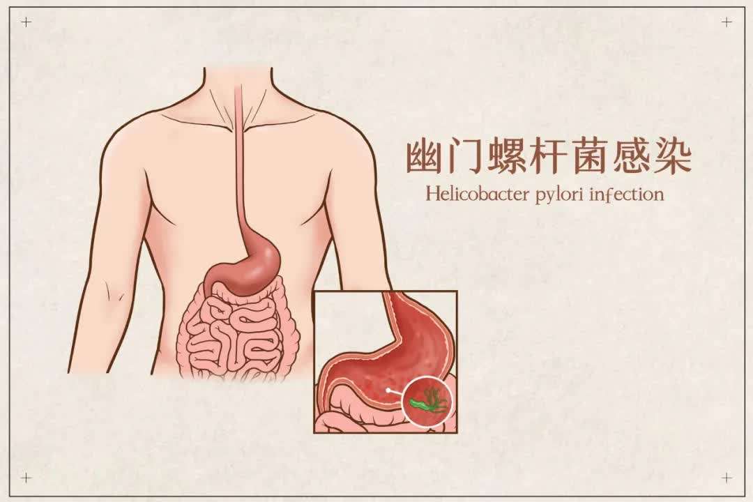 幽门螺杆菌怎么彻底治疗,幽门螺杆菌有哪些症状