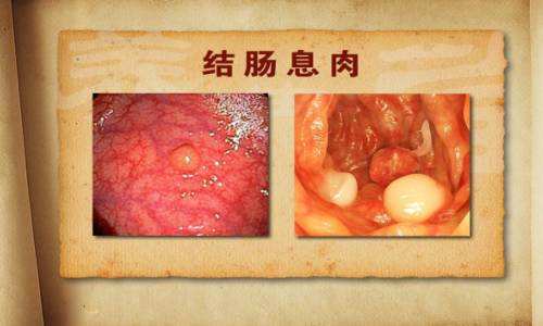 慢性结肠炎症状慢性结肠炎怎么治疗