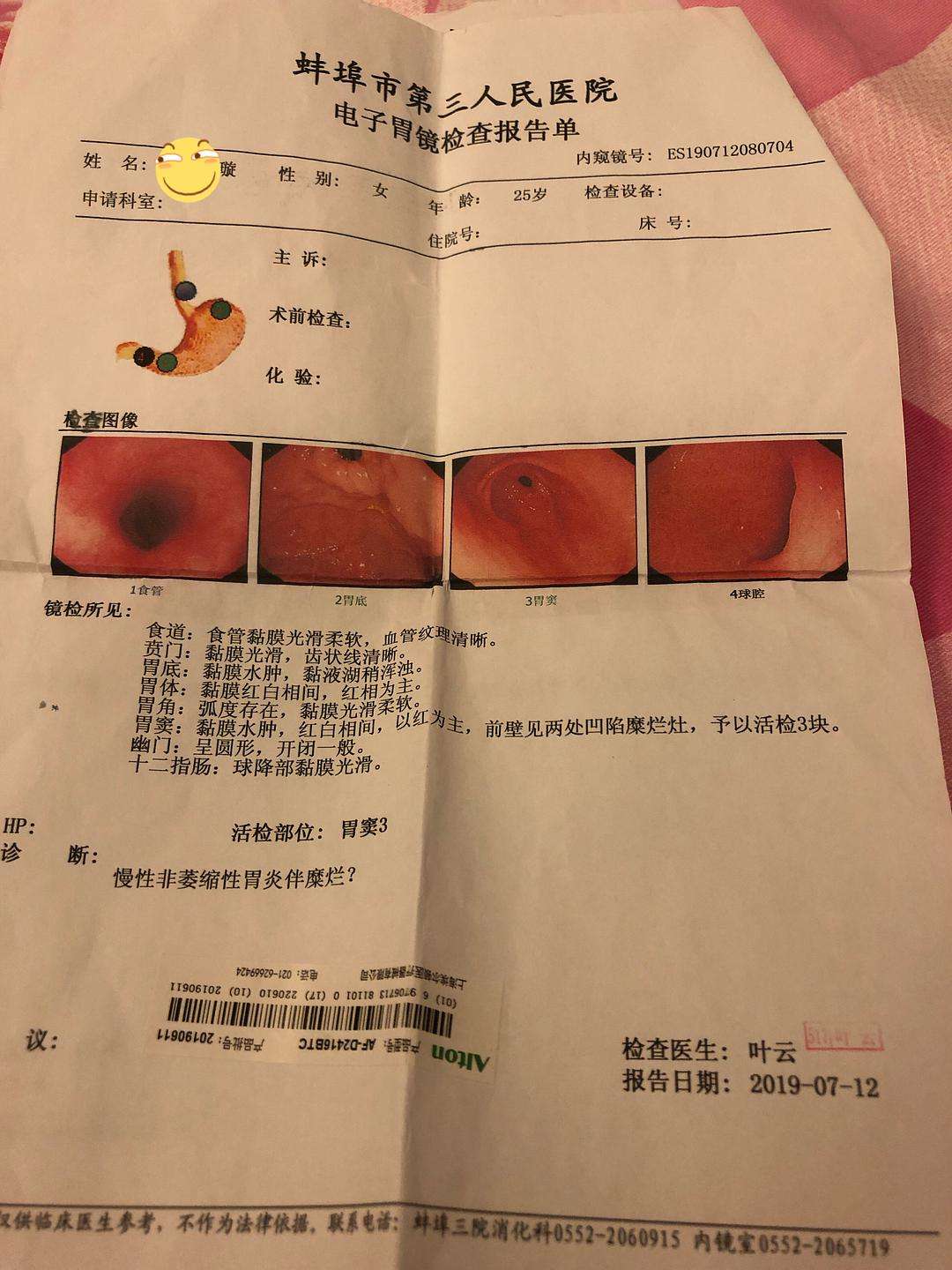 胆汁反流一年瘦了30斤,胆汁反流性胃炎严重吗
