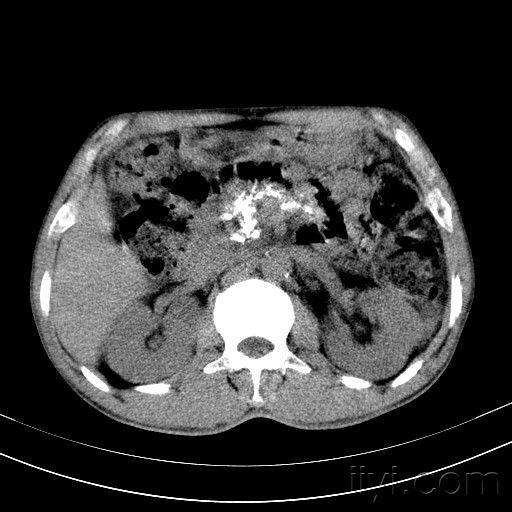 慢性胰腺炎一分钟自测胰腺炎