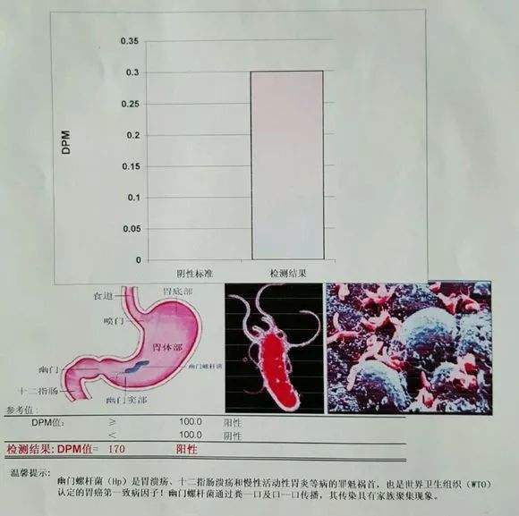 幽门螺旋杆菌怎么检查出来的体检查出幽门螺旋杆菌阳性是什么意思